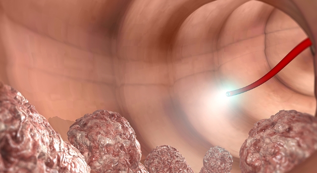 Pandemi, kolon kanserinde erken tanıyı engelliyor!