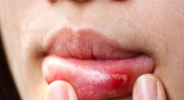 Alkol tüketiminde aşırılık ağız kanserine neden oluyor