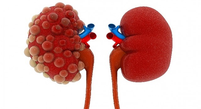 Abdi İbrahim Otsuka Medikal Direktörlüğü: Polistik Böbrek Hastalığının Seyrini Değiştirmek Mümkün