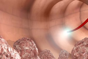 Pandemi, kolon kanserinde erken tanıyı engelliyor!