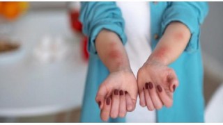 Ütopik Değil Ürtiker! - Prof. Dr. Ahmet Akçay