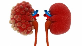 Abdi İbrahim Otsuka Medikal Direktörlüğü: Polistik Böbrek Hastalığının Seyrini Değiştirmek Mümkün